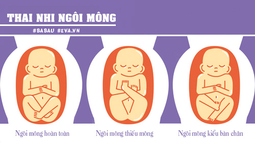 Những vị trí nằm “oái oăm” của thai nhi trong bụng mẹ